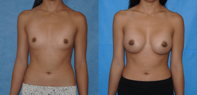 Saline Breast Implant