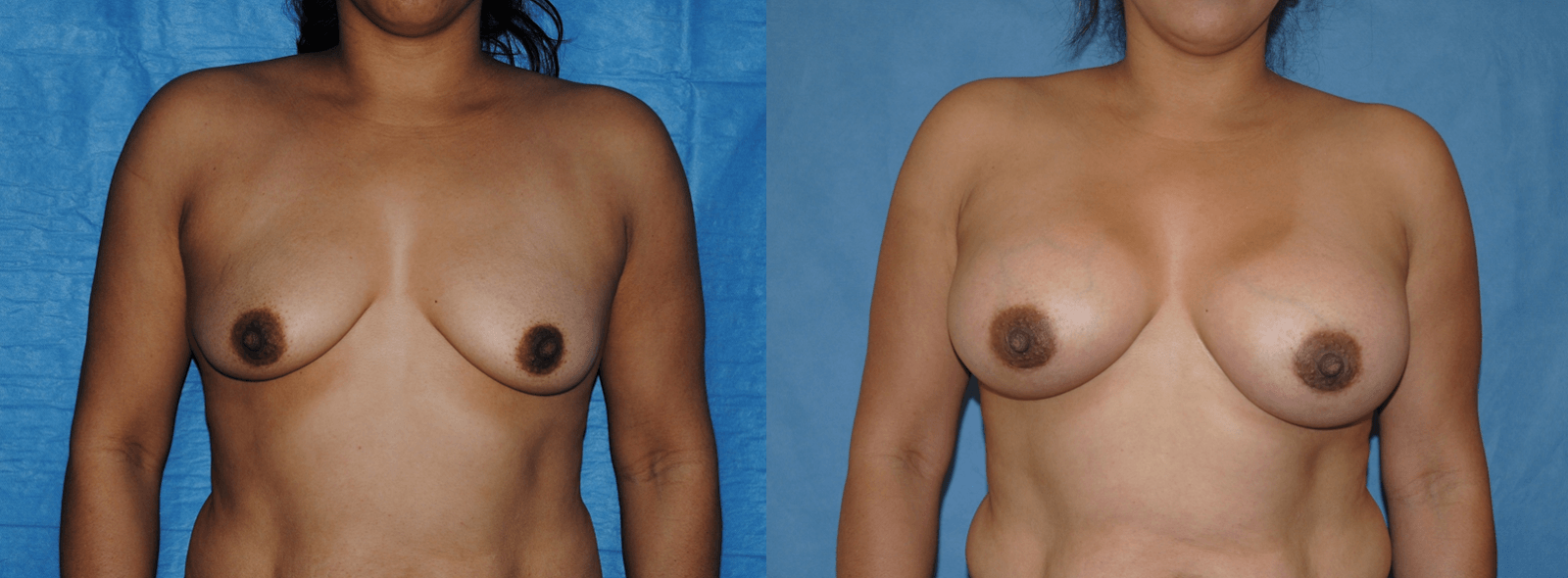 Breast Augmentation and the Periareolar approach. The dimensions of the areola.
