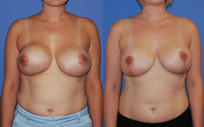 Capsular Contracture: Reconstructive Breast Surgery or Revision Aesthetic Breast Surgery?