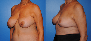 Why Get a Breast Reduction?
