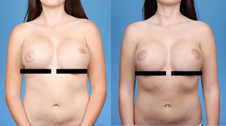 How to Achieve Breast Symmetry