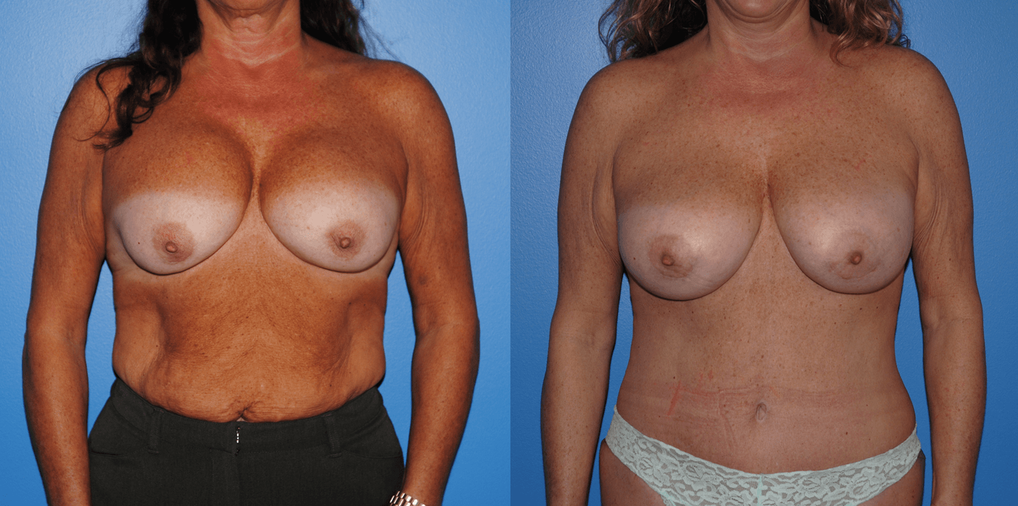 Capsular Contracture Surgery & Revision Breast Surgery