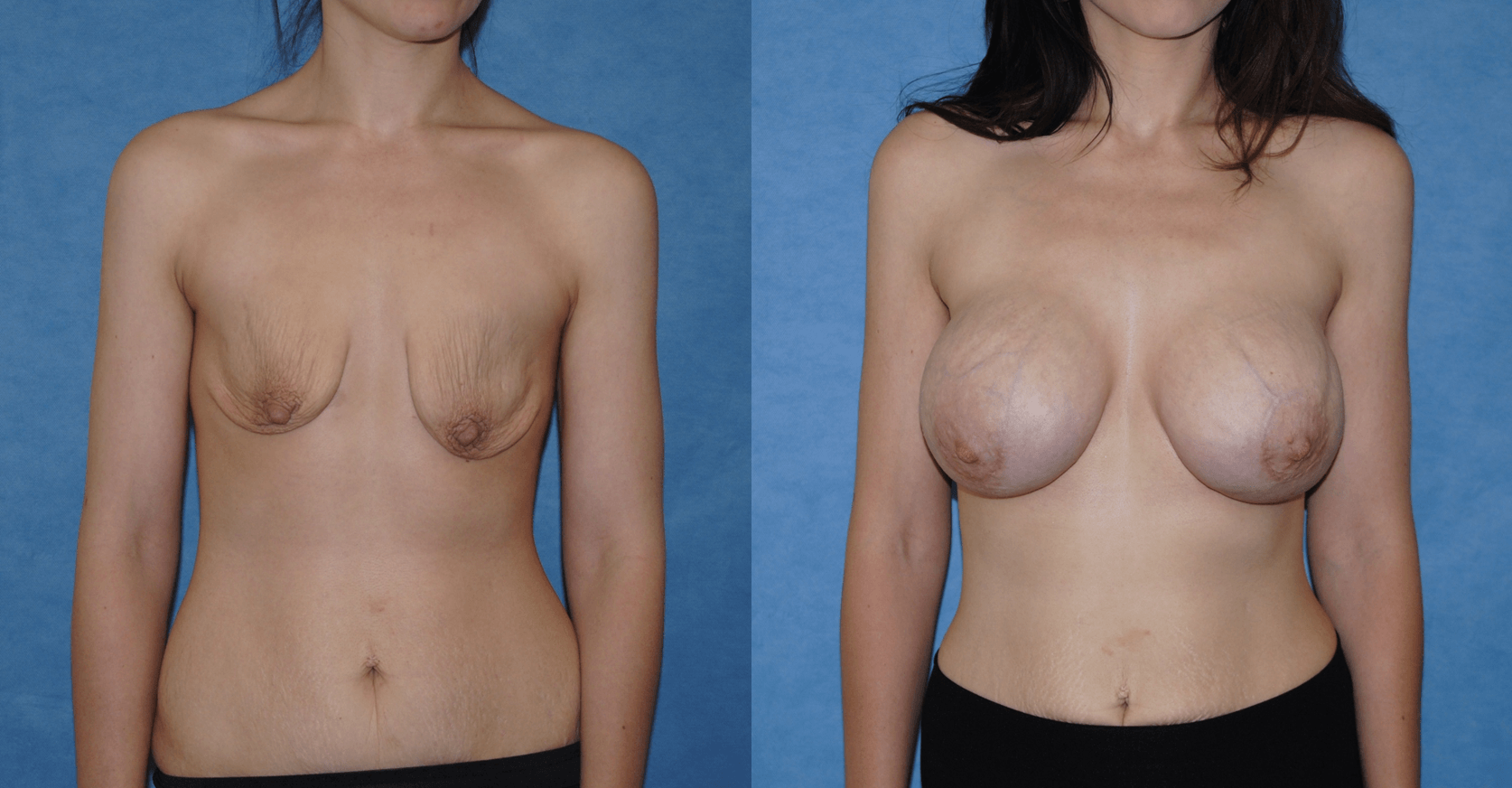 Breast Augmentation Reasons