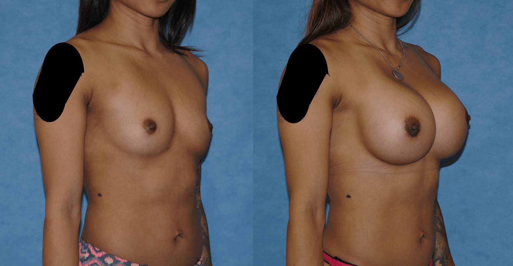 Breast Implant Incision Choices
