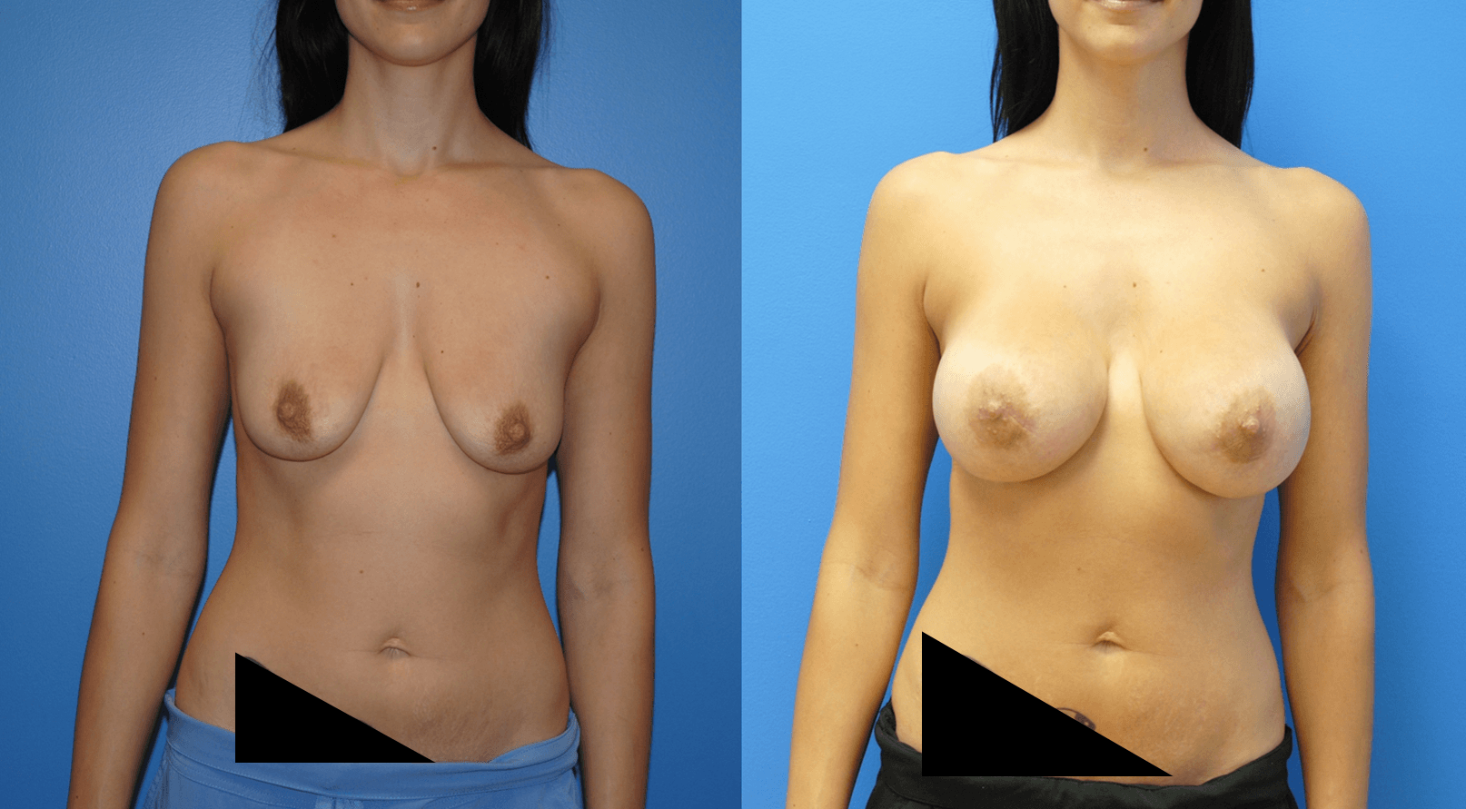 Breast Augmentation for the Summer.