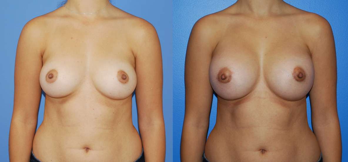 The Journey of Breast Augmentation with Silicone Implants