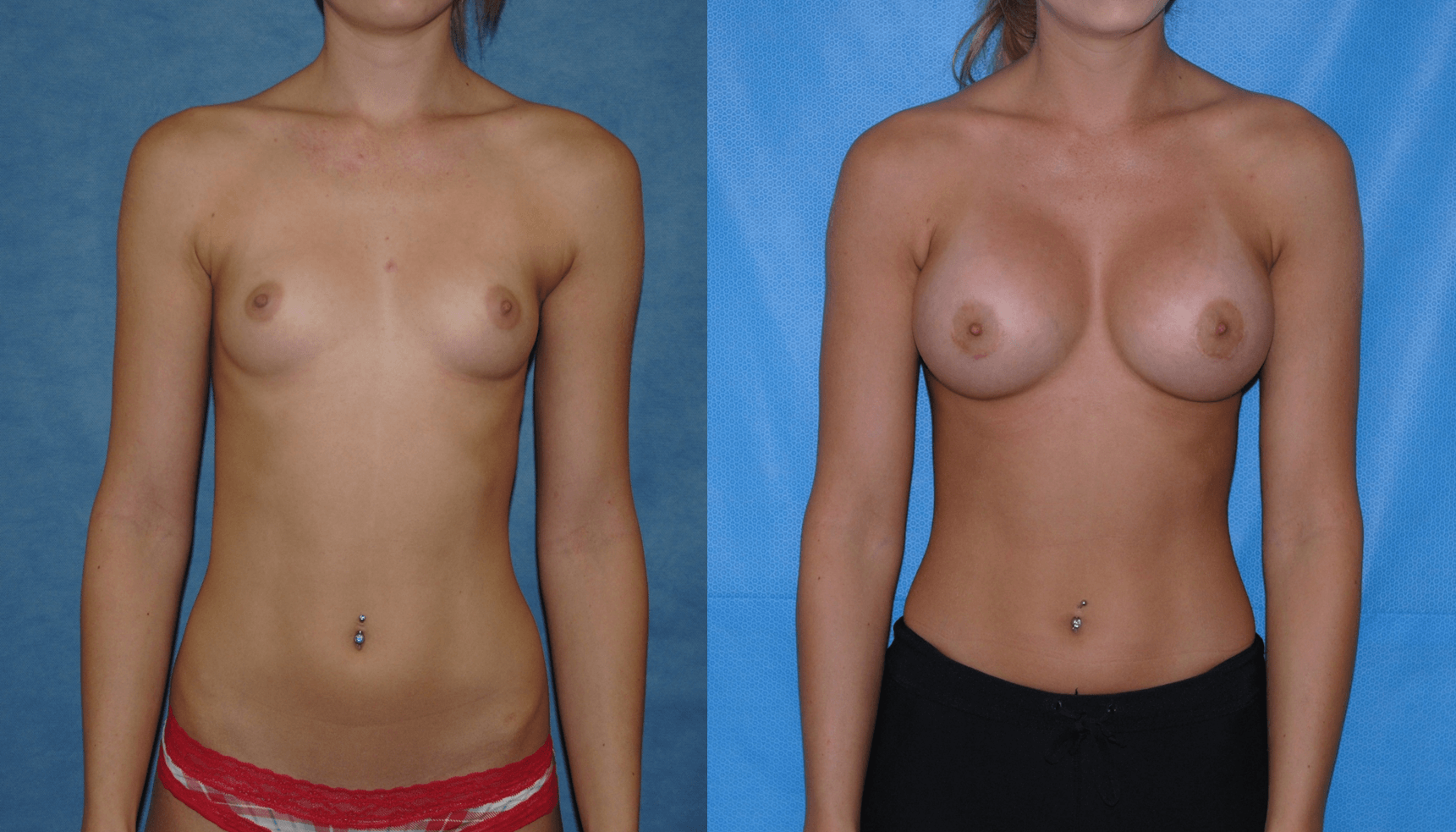 Breast Augmentation: Incision Choices