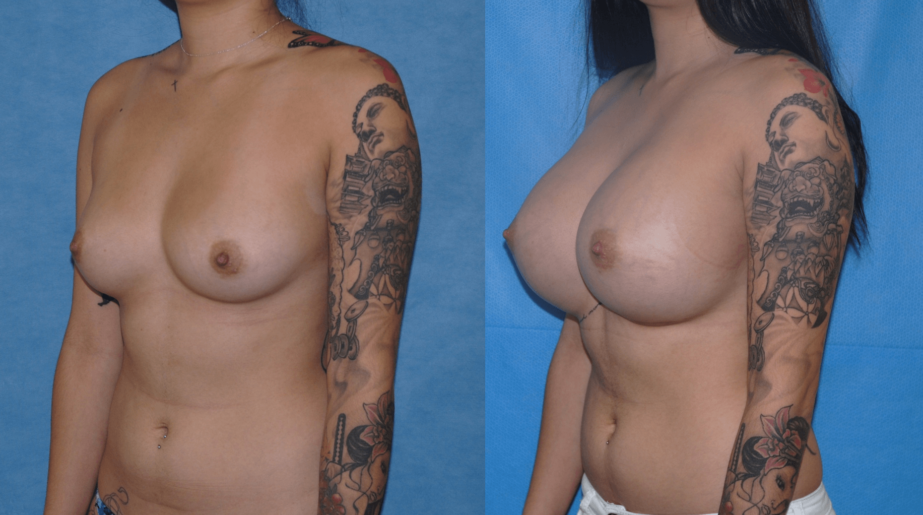 Breast Augmentation-Newport Beach-Brian Dickinson-Silicone Gel Breast Implants