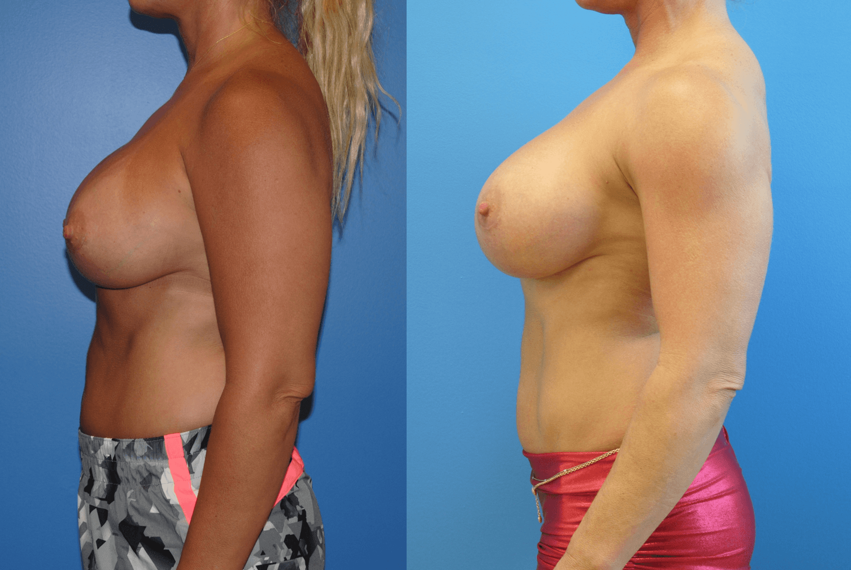 Silicone Gel Breast Implant Orange County