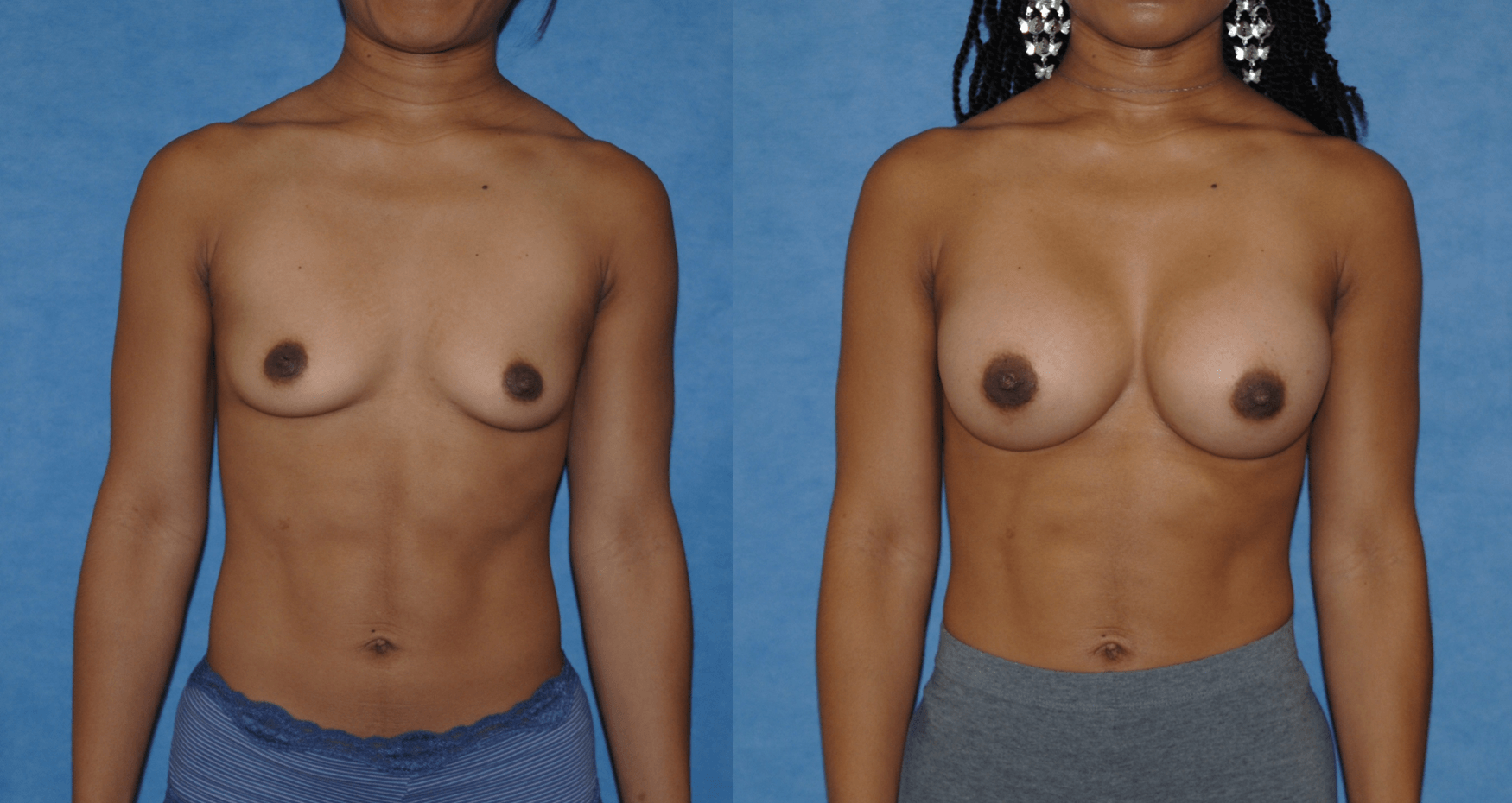 The Natural Looking Breast Augmentation