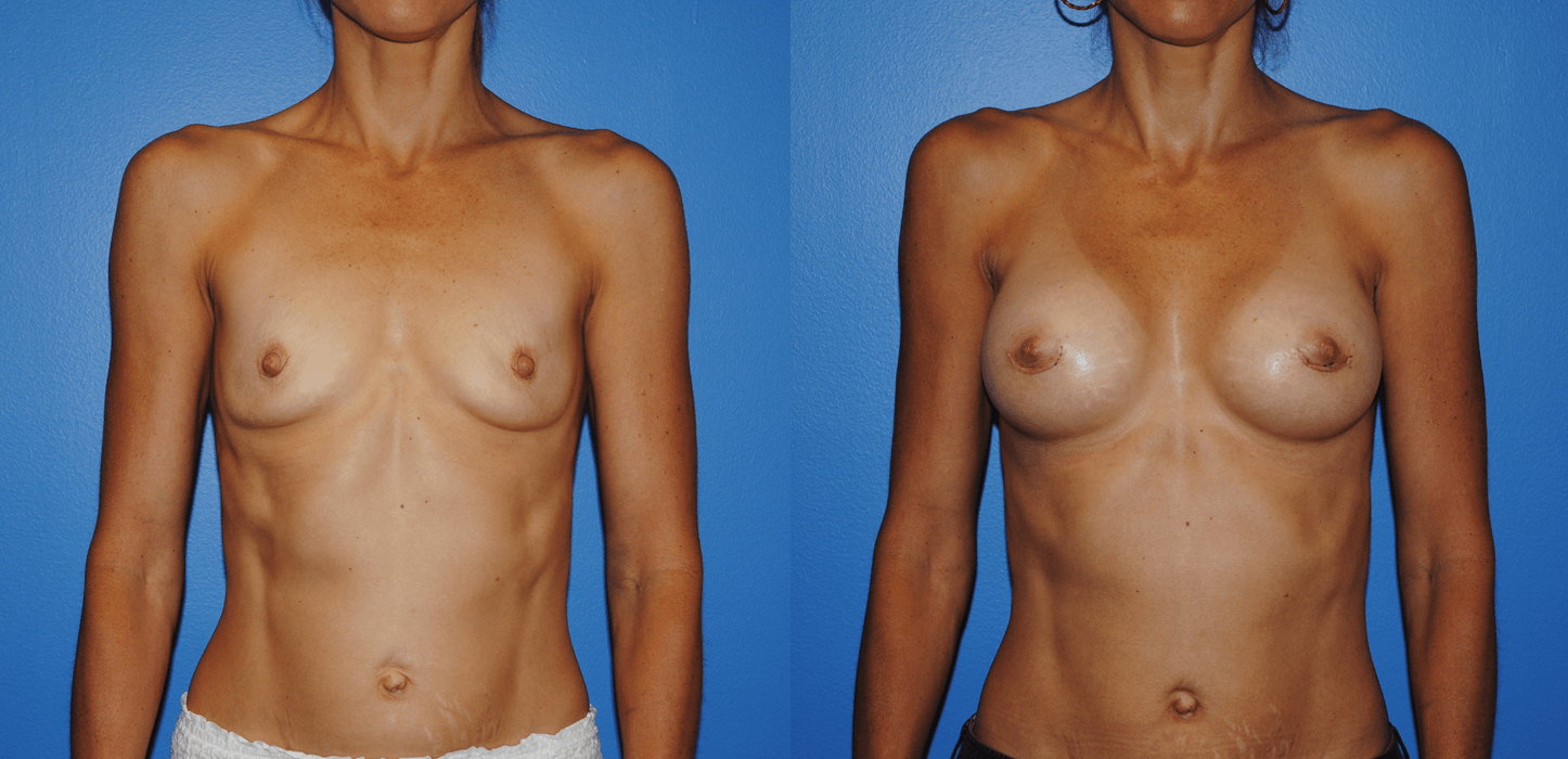 Breast Augmentation-Recovery