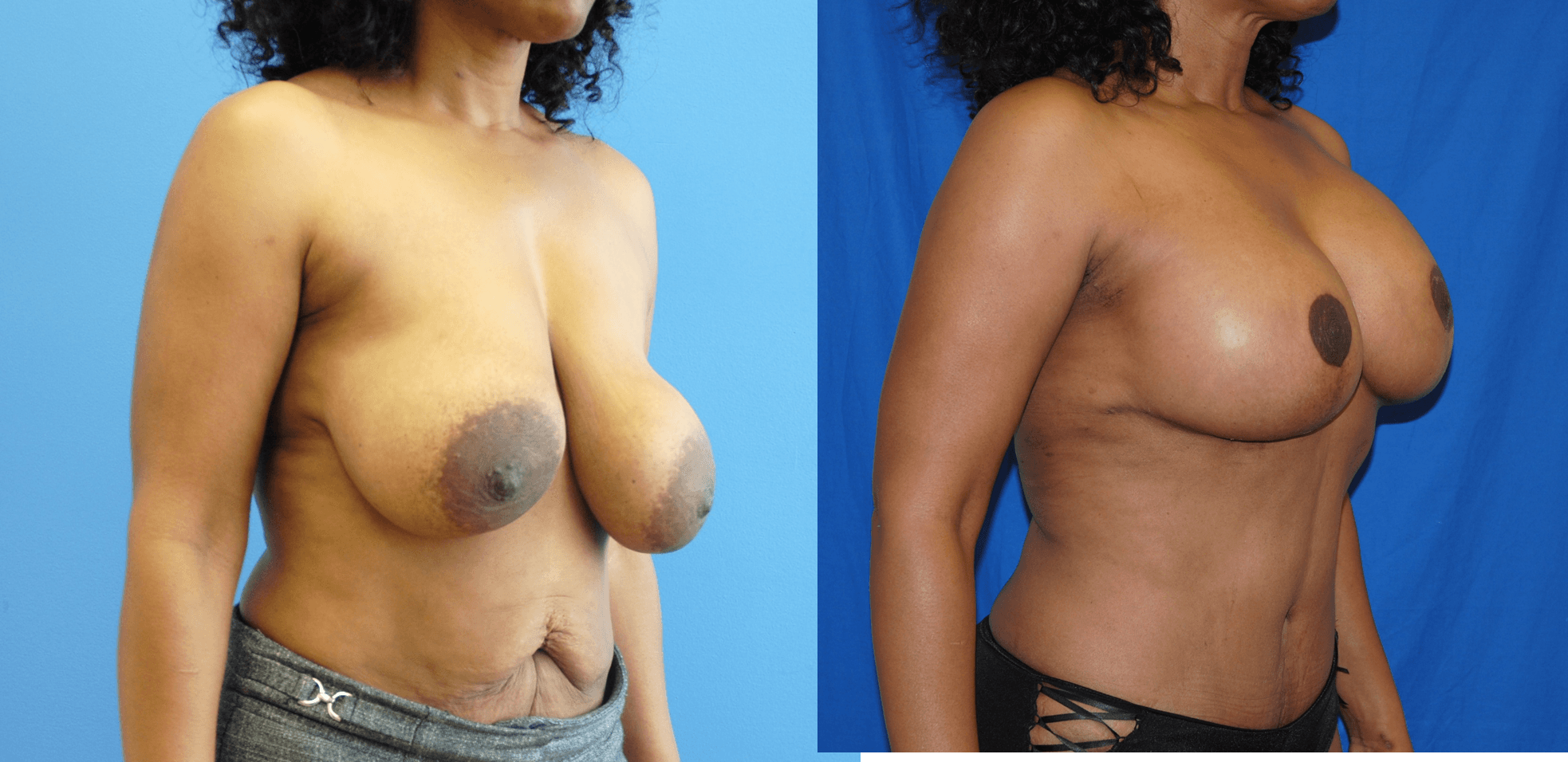 Breast Lift with Removal and Replacement of Breast Implant