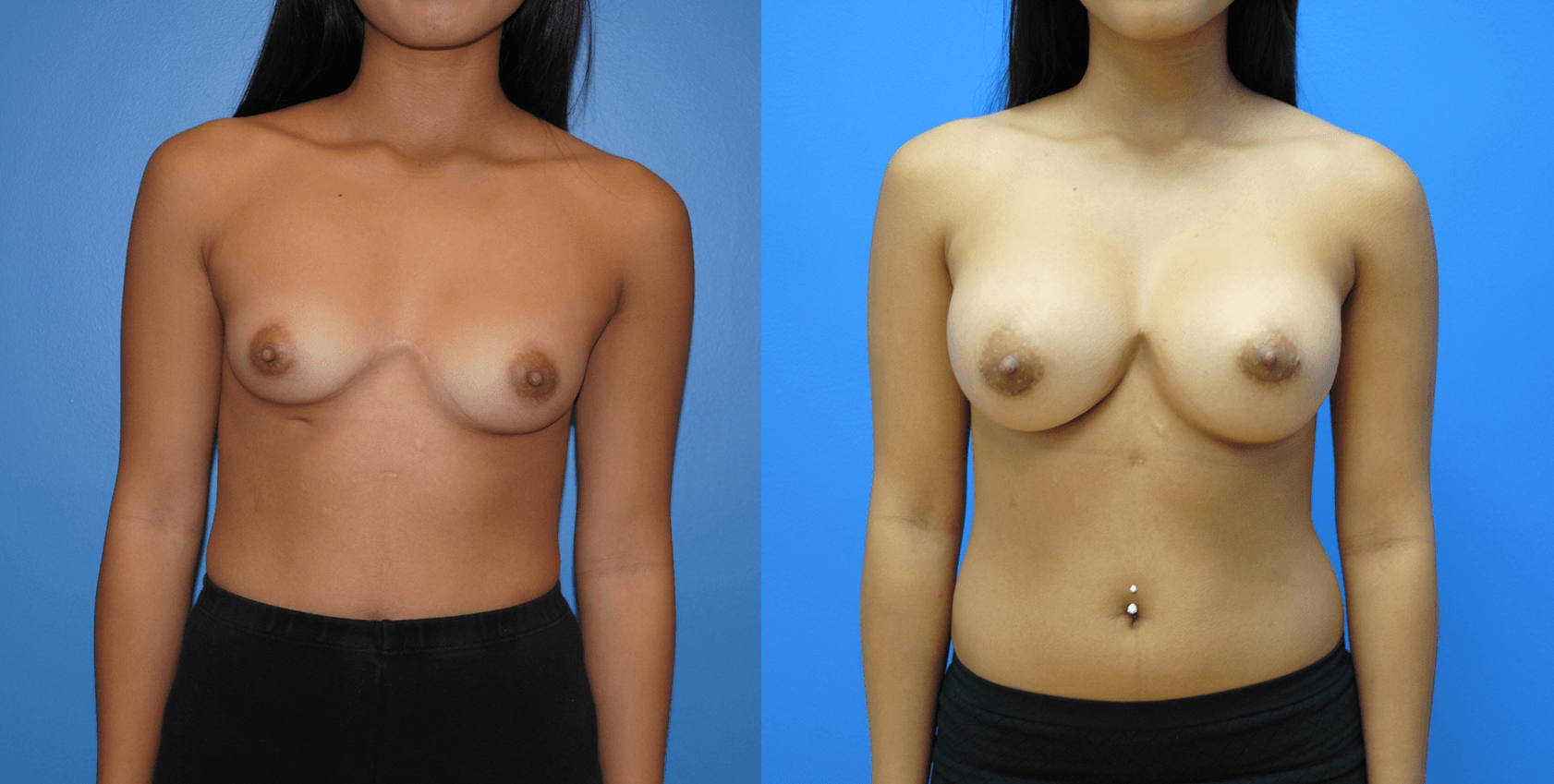Breast Augmentation for Breast Asymmetry