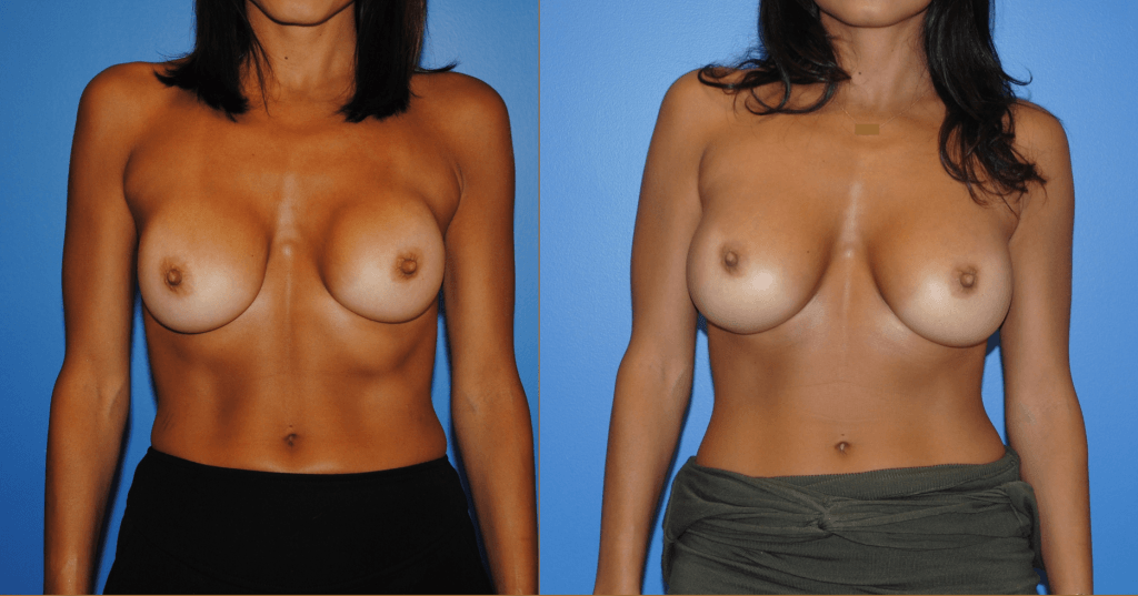 Capsular Contracture Revision Augmentation