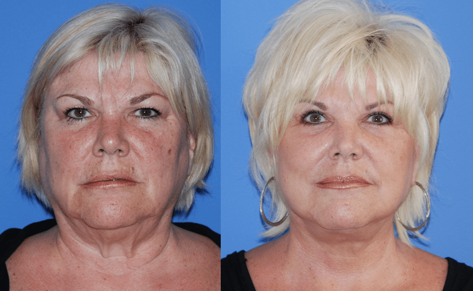 Facelift Surgery