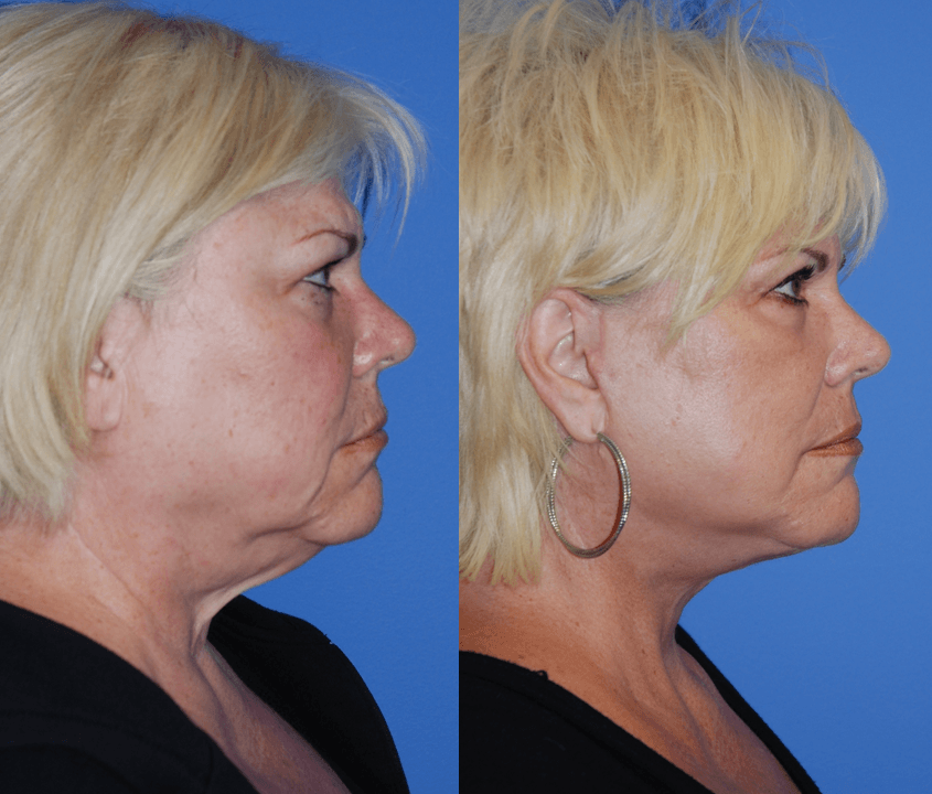 Lower Face and Necklift