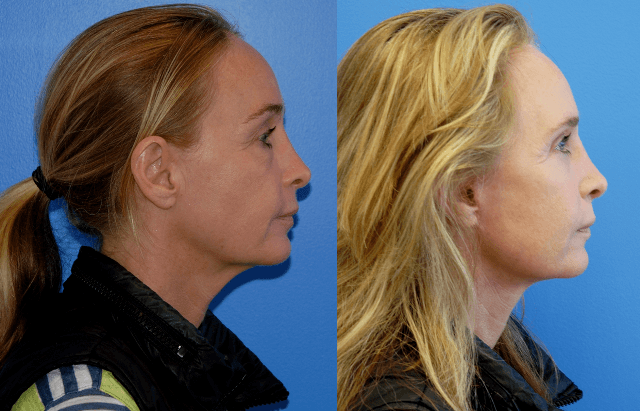 Lower Face, Necklift, and Eyelid Surgery