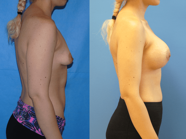 Breast Augmentation-Orange County-Tuberous Breast Deformity-Brian Dickinson, M.D.