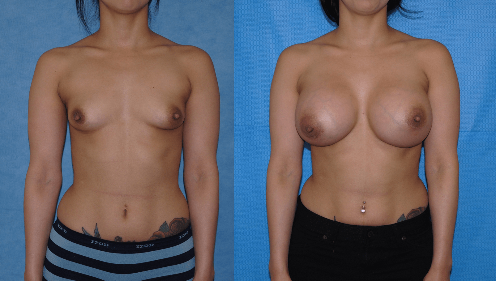 Tuberous Breast Deformity-OC-Costa Mesa-Dickinson