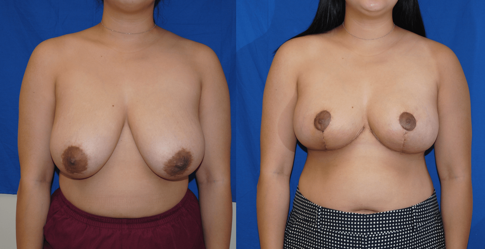 Are You a Breast Reduction Candidate?