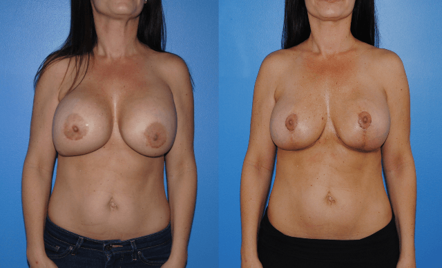 Removal-Replacment-Mastopexy - Brian Dickinson, M.D.