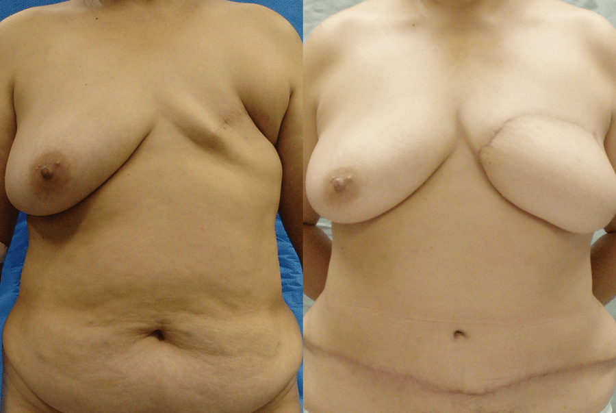 Autologous Breast Reconstruction. DIEP Flaps. Second Stage Procedures