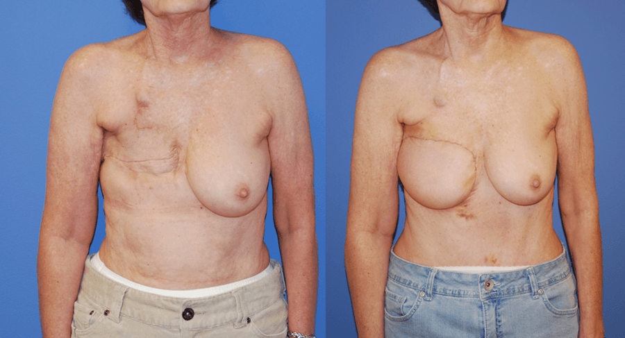 Delayed Breast Reconstruction Following Radiation Therapy