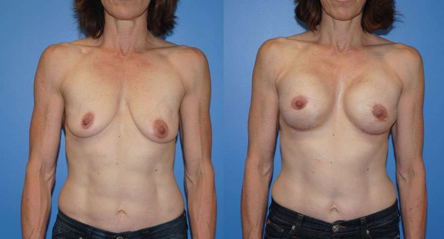 Breast Reconstruction Following Mastectomy