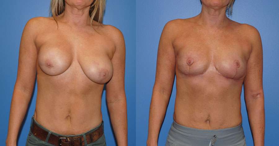 Breast Reconstruction following Lumpecomy & Radiation