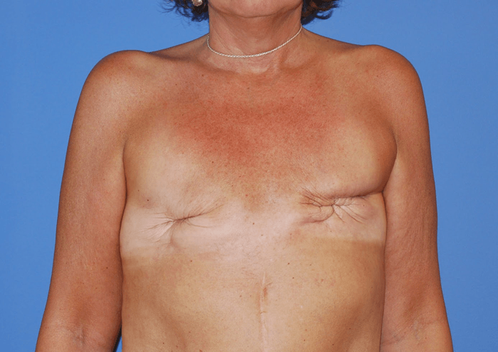 DIEP Flaps for Breast Reconstruction. Post-Operative