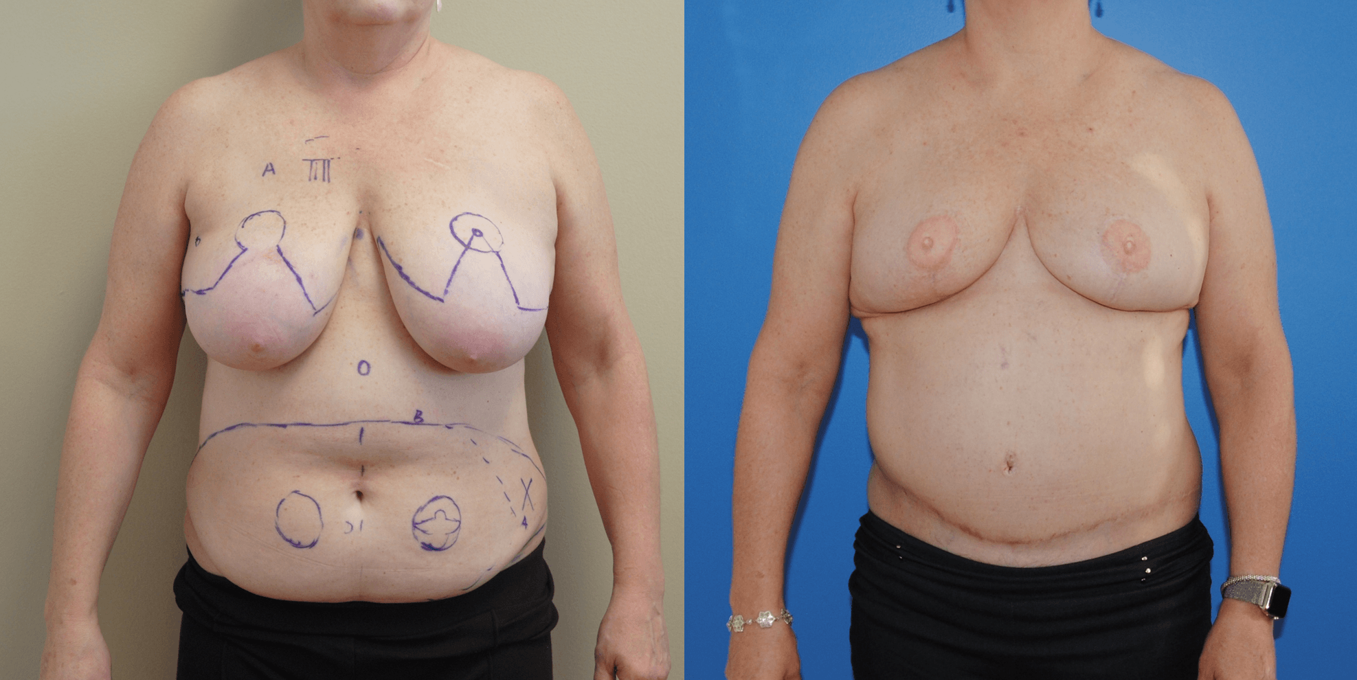 Bilateral DIEP Breast Reconstruction with Wise Pattern Mastectomy