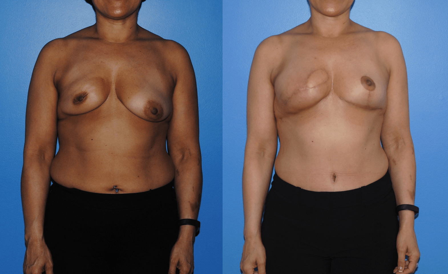 DIEP Flap Breast Reconstruction, to Replace Medial Breast Skin Following Mastectomy
