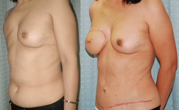 DIEP Flaps. Second Stage Breast Reconstruction. Nipple Areola Complex Reconstruction