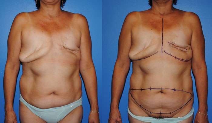 DIEP flap before and after 