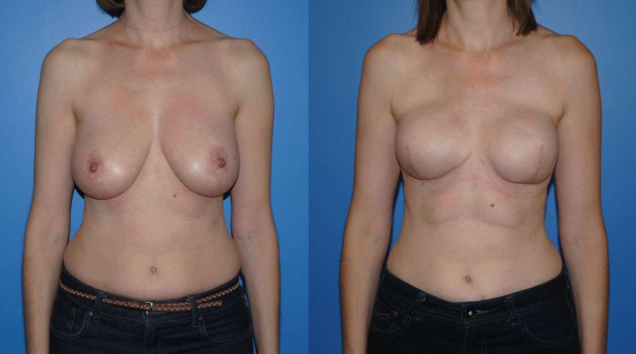 Implant Breast Reconstruction Following Mastectomy