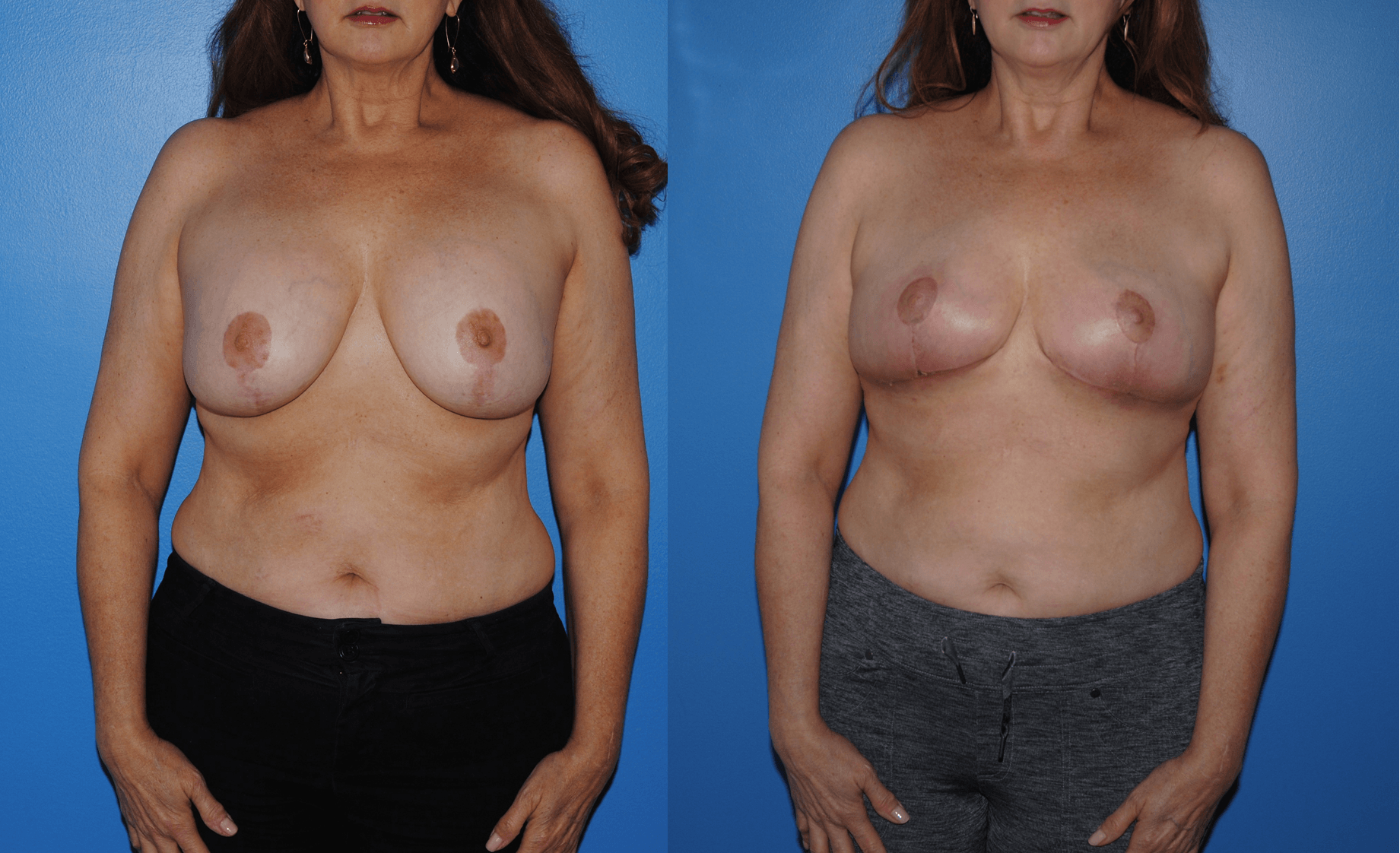 Mastopexy with Removal of Implants