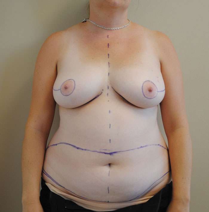 Bilateral DIEP Flaps for Autologous Breast Reconstruction