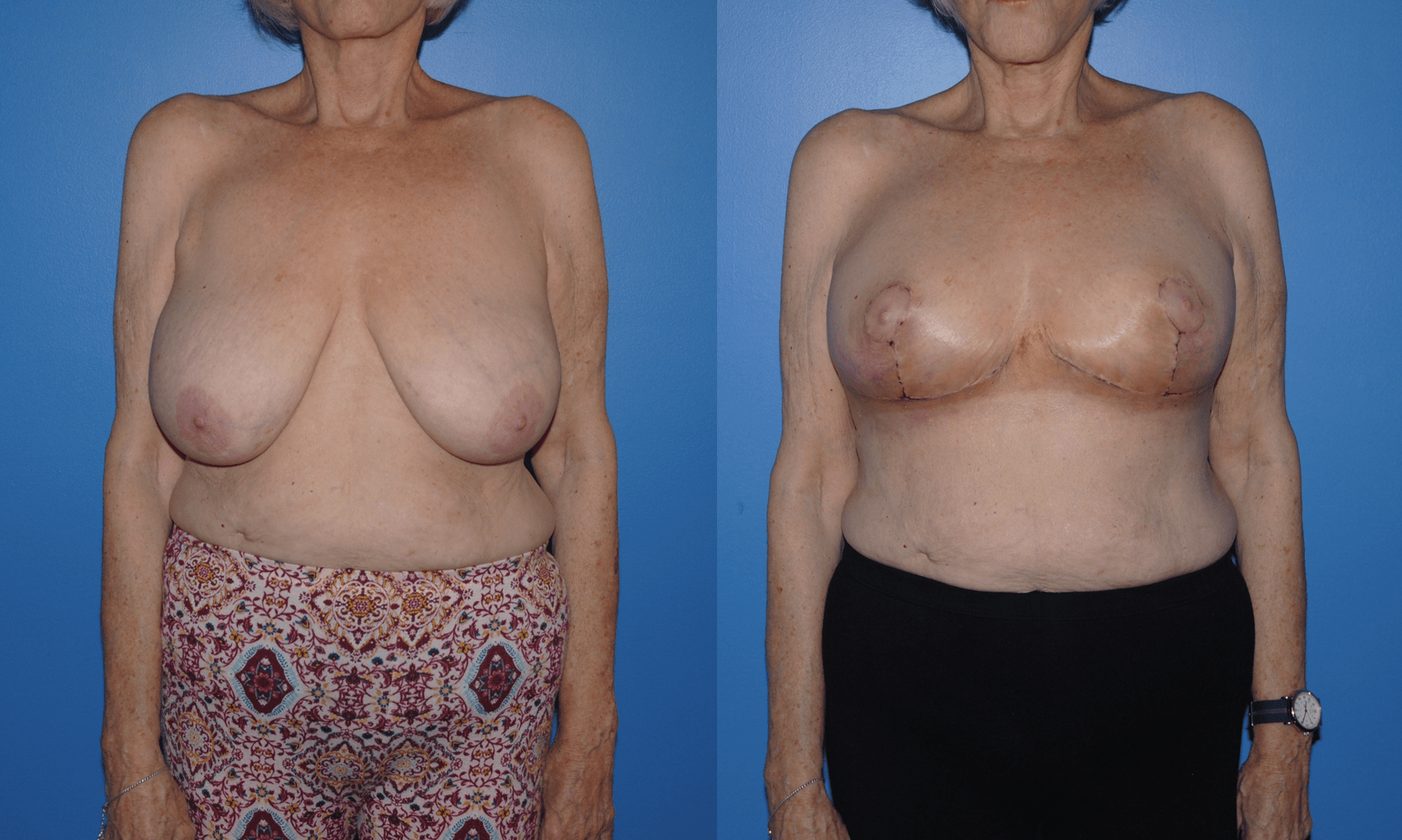 Oncoplastic Reconstruction Following Lumpectomy for Breast Conservation. Early Post-Operative Results. What to Expect?