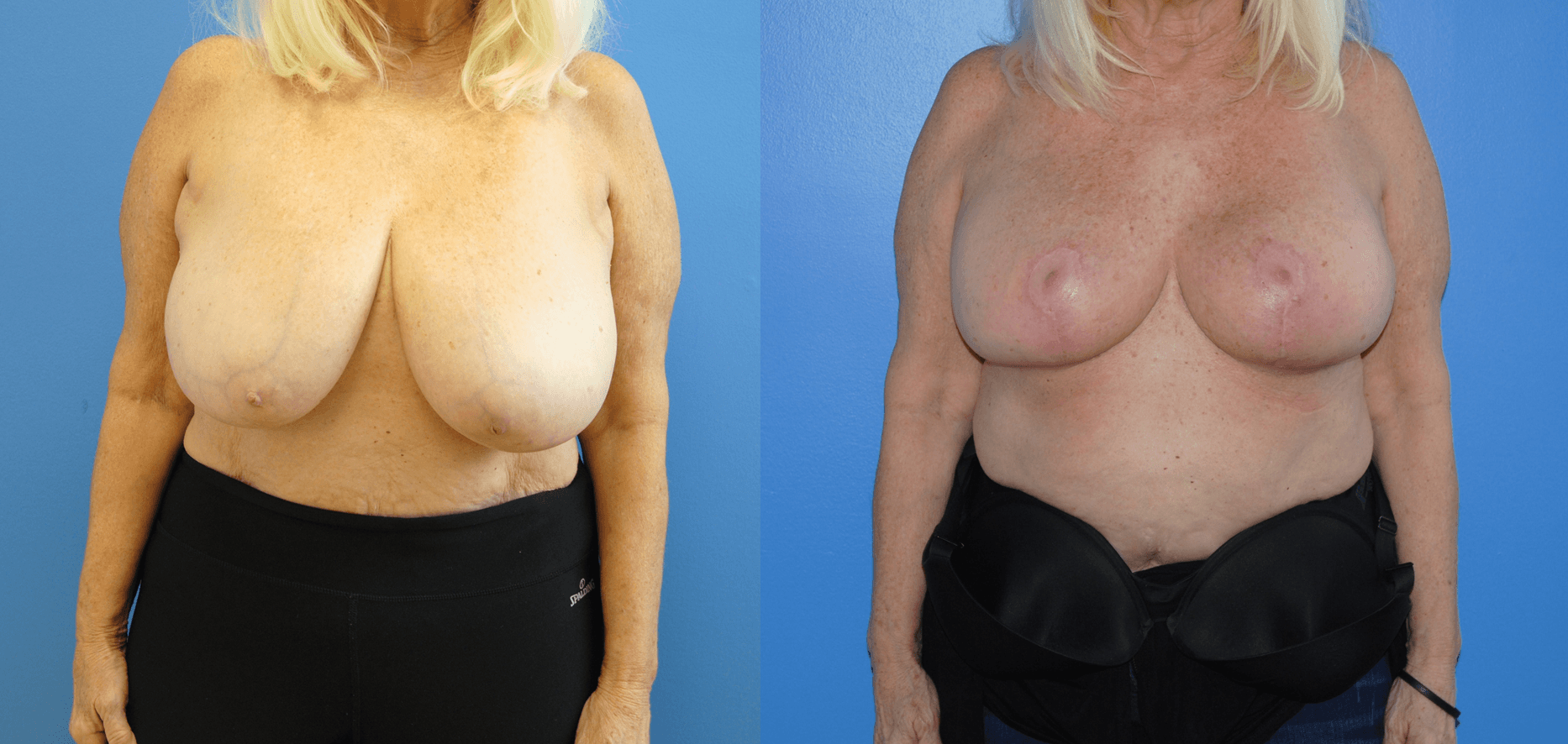 Oncoplastic Reconstruction of the Breast. Breast Conservation.