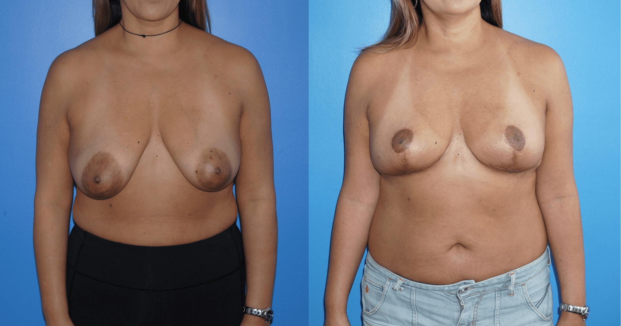Closure of Lumpectomy Defect with Oncoplastic Techniques