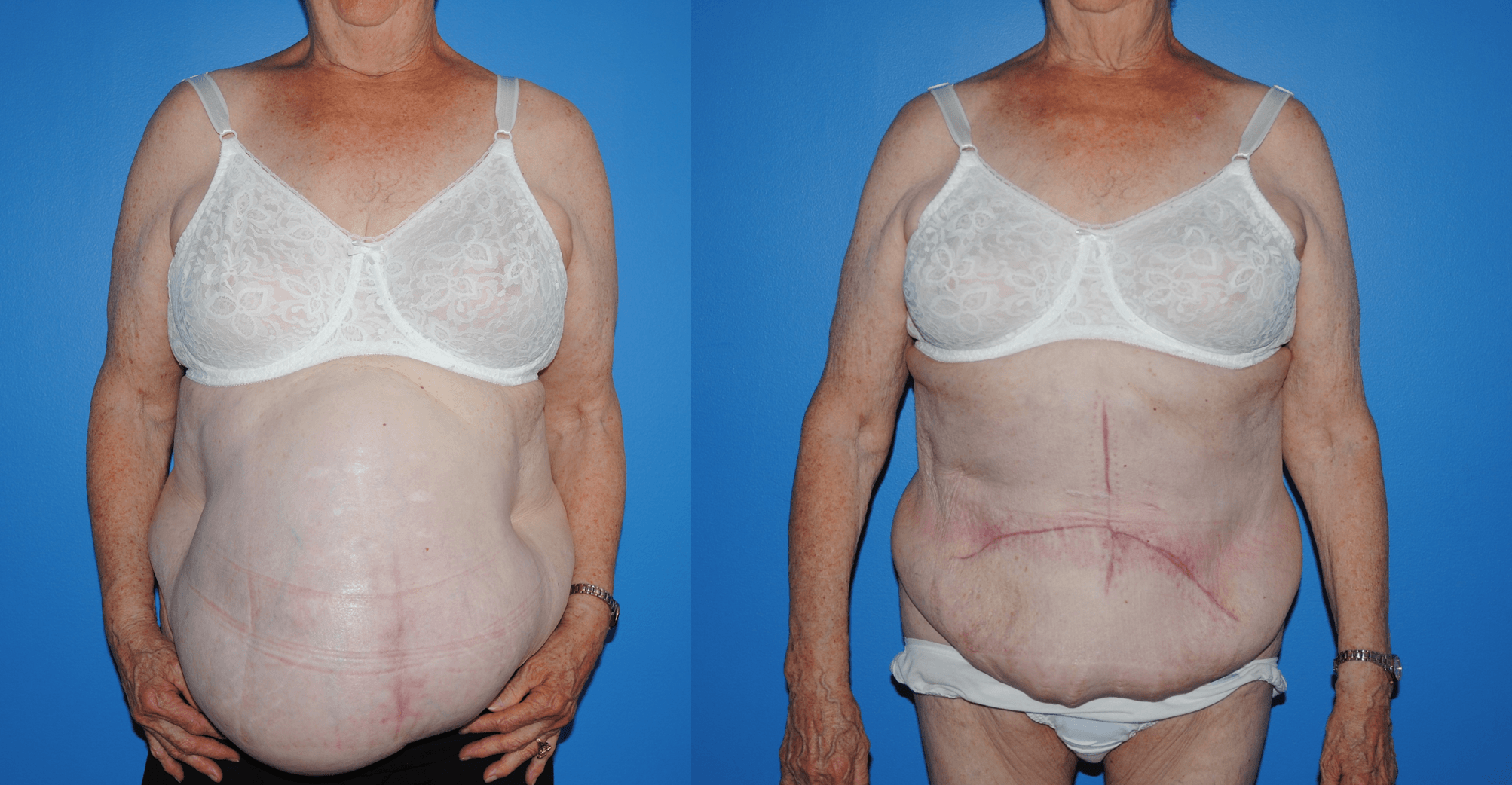 Center for Hernia Repair & Abdominal Wall Reconstruction - Inguinal Hernia