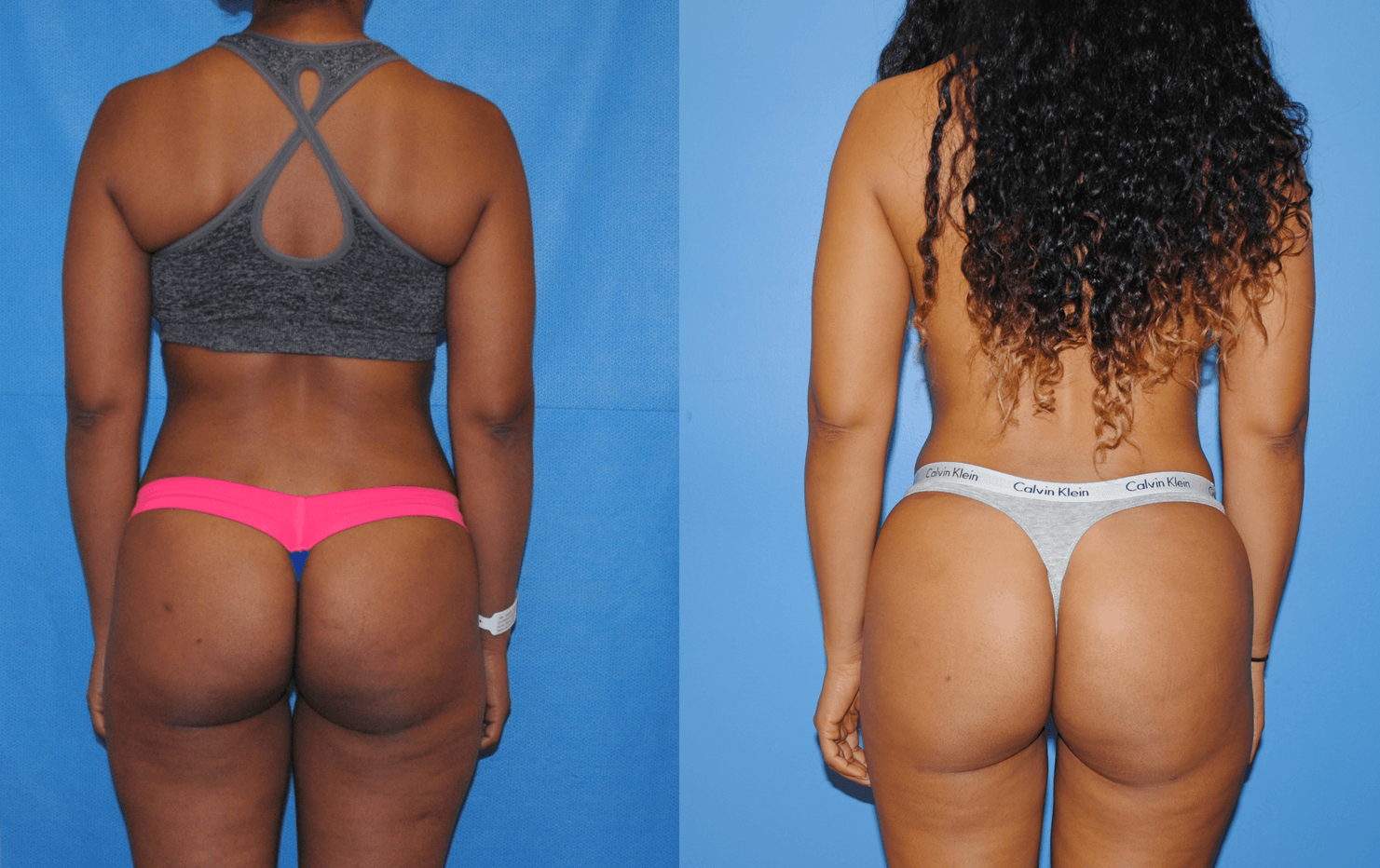 Brazilian Butt Lift – Gluteal Fat Transfer