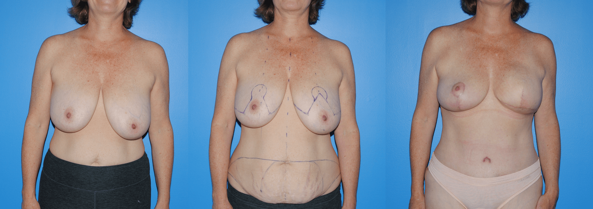 Breast Reconstruction with Autologous Tissue or Flap Reconstruction