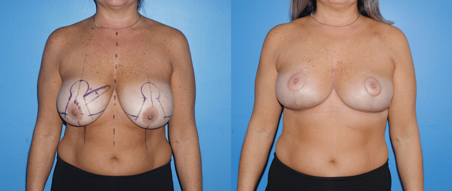 Oncoplastic Breast Reconstruction Following Lumpectomy
