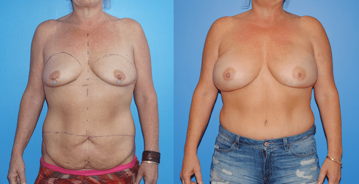 Bilateral DIEP Flap Reconstruction for Bilateral Nipple Sparing Mastectomy