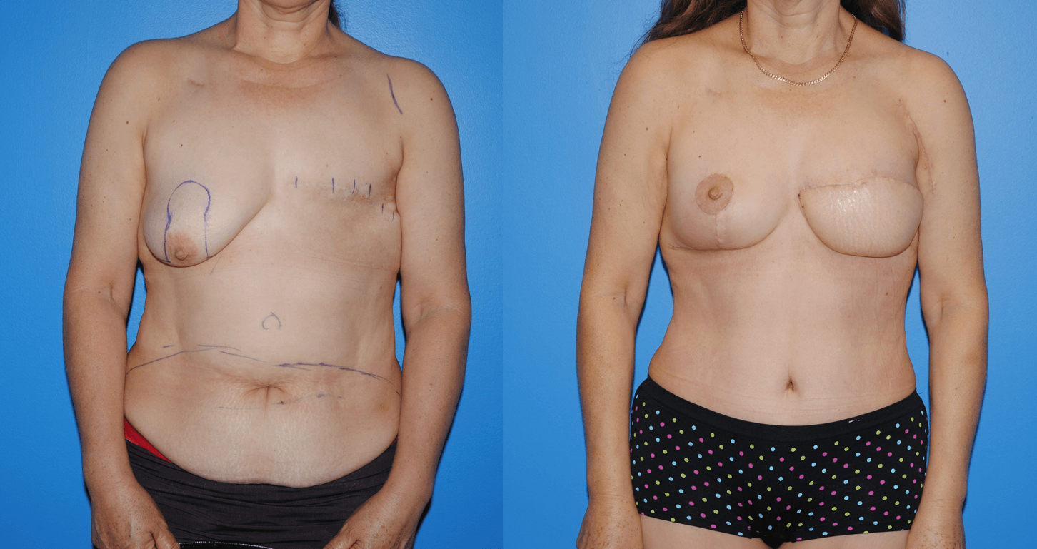 Early Post-Operative Results for Delayed Unilateral Flap Reconstruction following Mastectomy and Radiation