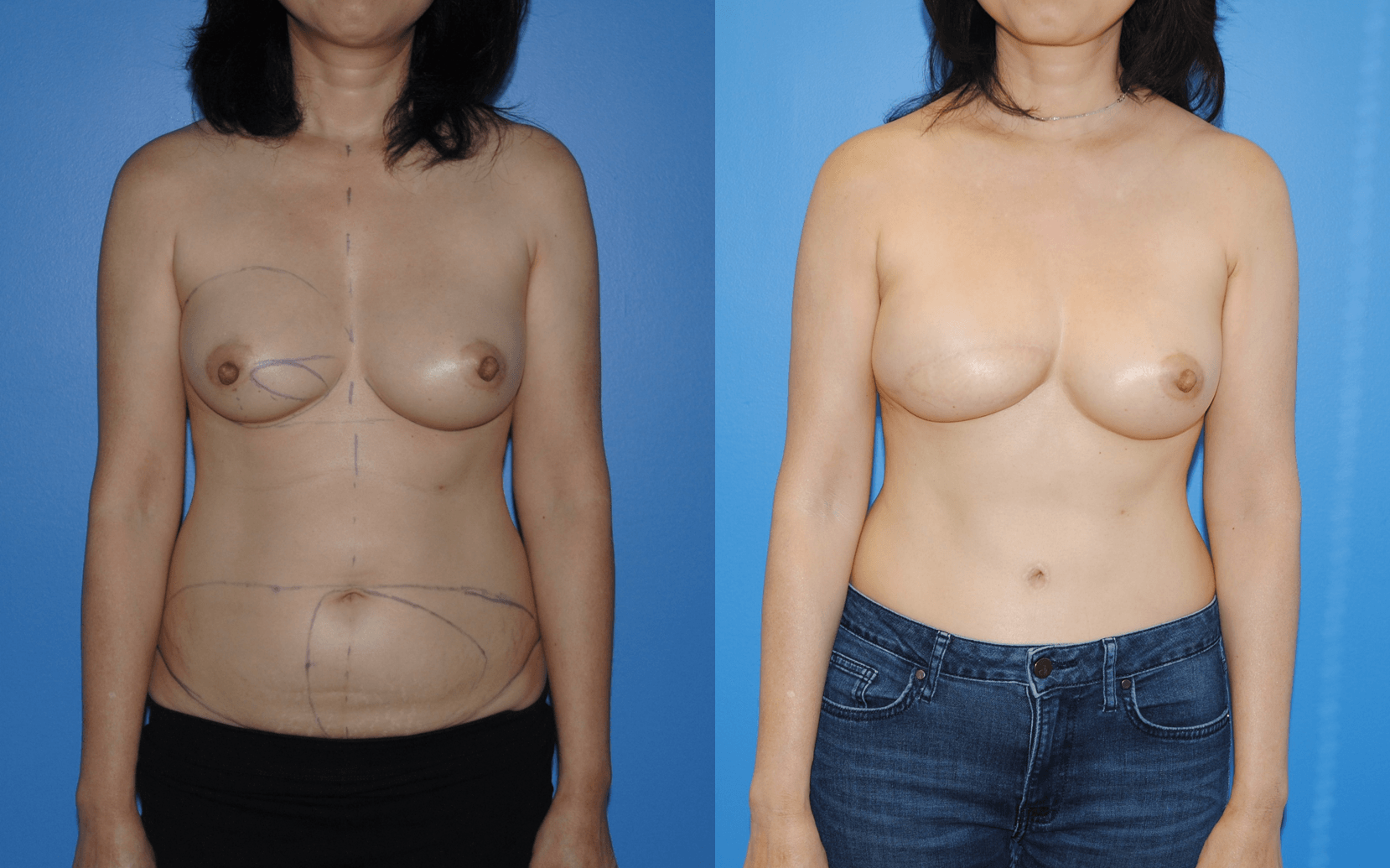 Deep Inferior Epigastric Artery Perforator Flaps for Breast Reconstruction