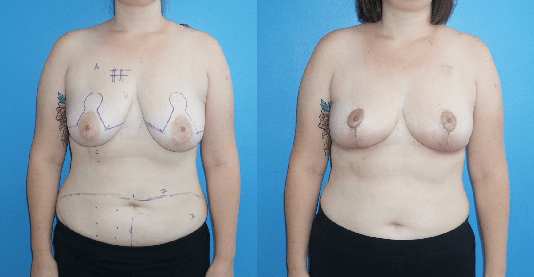 Oncoplastic Reconstruction of Following Lumpectomy and DIEP Flap Following Mastectomy