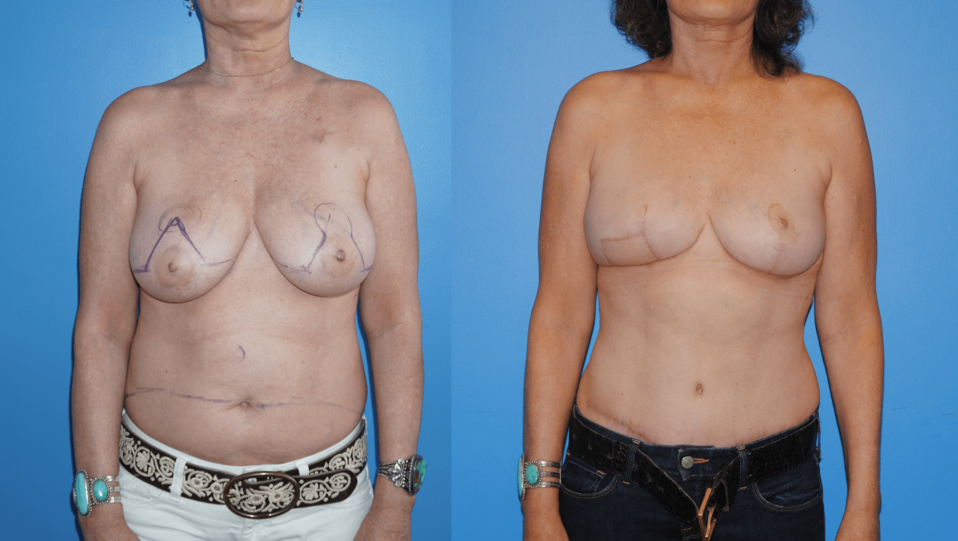 Unilateral DIEP Flap Reconstruction and Contralateral Mastopexy