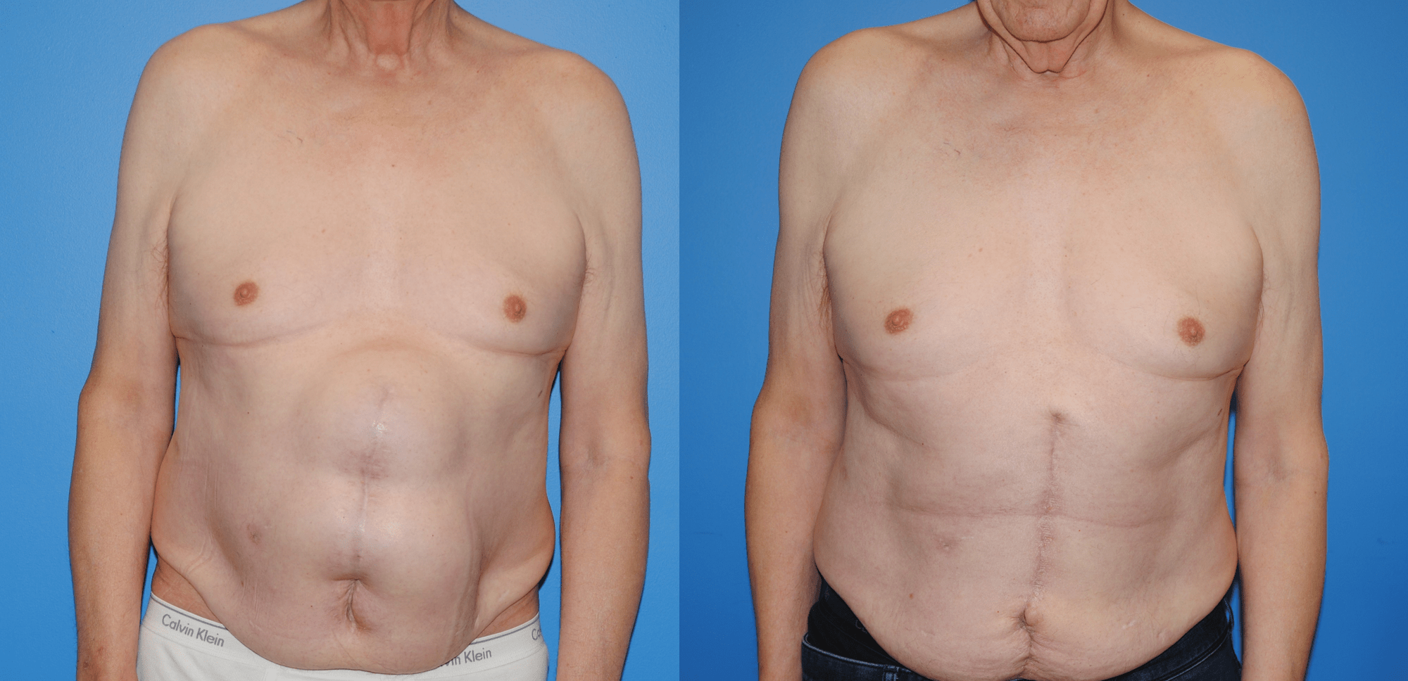 Hernia Repair and Abdominal Wall Reconstruction with Strattice Acellular Dermal Matrix